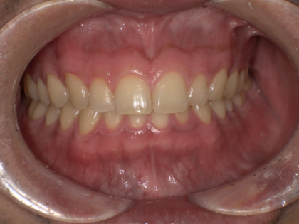 ガムピーリング1回目術後