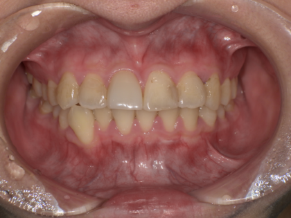 初診　ホームホワイトニング前