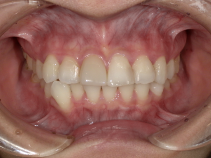 ホームホワイトニング後