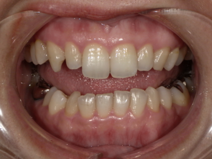 デュアルホワイトニング前