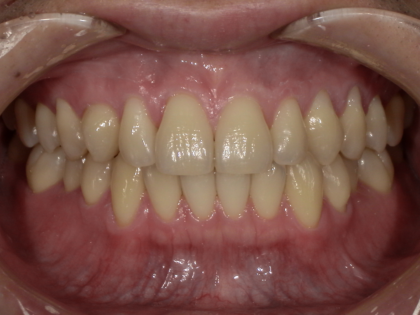 ホームホワイトニング術前