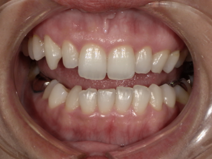 デュアルホワイトニング後